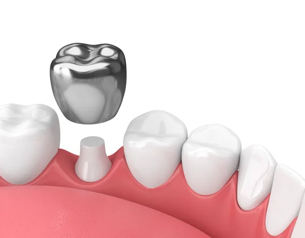 Essential Guide to Choosing the Right Material for Your Dental Crowns Palm Beach Gardens