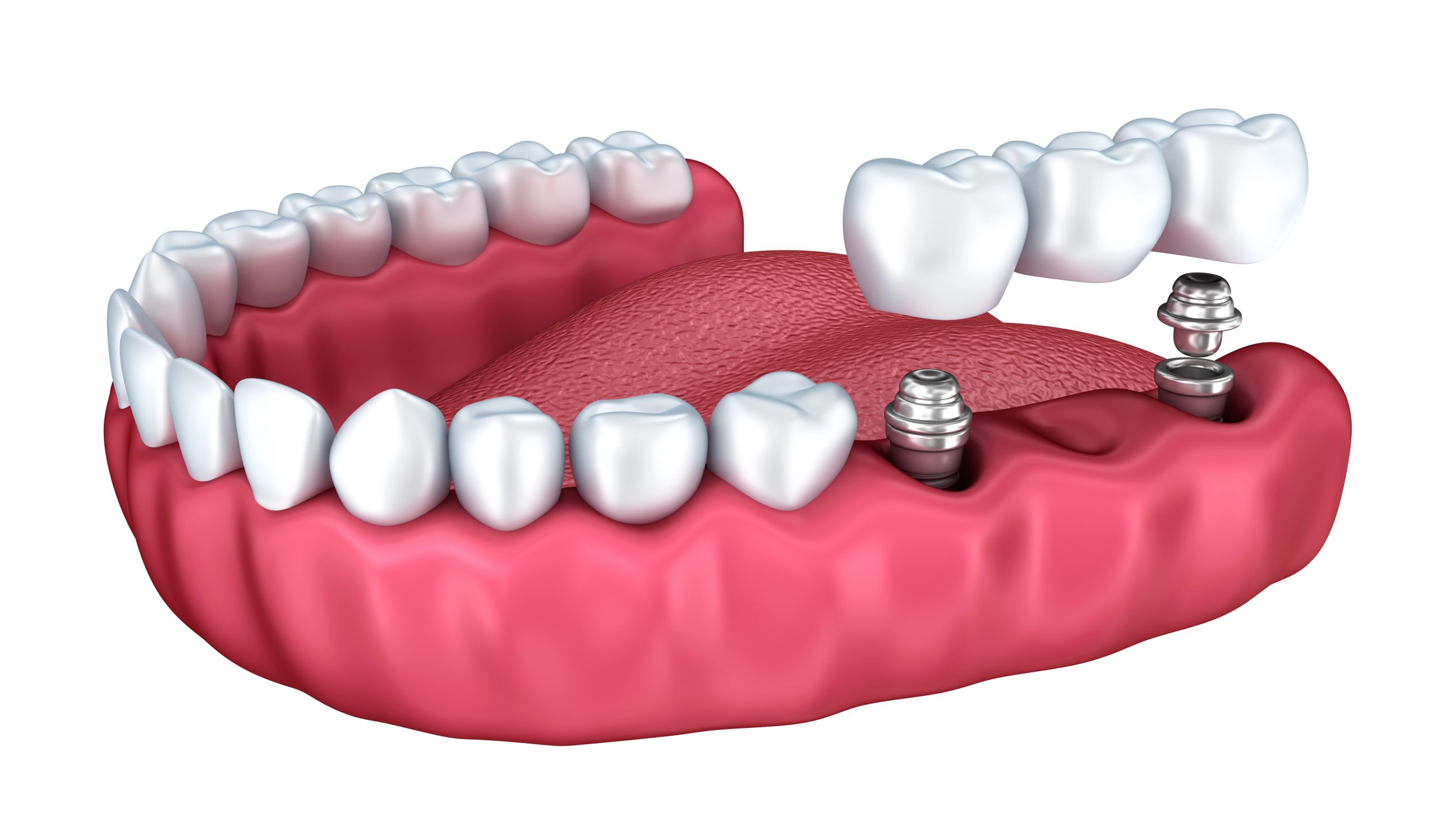 Are Dental Bridges the Right Solution for Your Missing Teeth in Palm Beach Gardens?